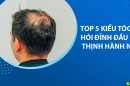 TOP 5 kiểu tóc che hói đỉnh đầu nam thịnh hành nhất hiện nay