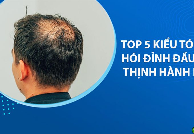 TOP 5 kiểu tóc che hói đỉnh đầu nam thịnh hành nhất hiện nay