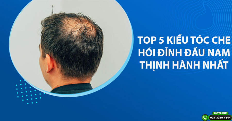 TOP 5 kiểu tóc che hói đỉnh đầu nam thịnh hành nhất hiện nay