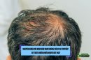 Nguyên nhân hói đỉnh đầu nam không chỉ do di truyền? Sự thật khiến nhiều người bất ngờ