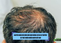Nguyên nhân hói đỉnh đầu nam không chỉ do di truyền? Sự thật khiến nhiều người bất ngờ
