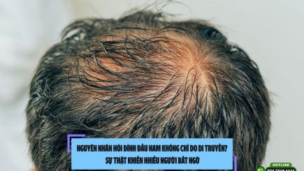 Nguyên nhân hói đỉnh đầu nam không chỉ do di truyền? Sự thật khiến nhiều người bất ngờ