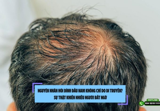 Nguyên nhân hói đỉnh đầu nam không chỉ do di truyền? Sự thật khiến nhiều người bất ngờ