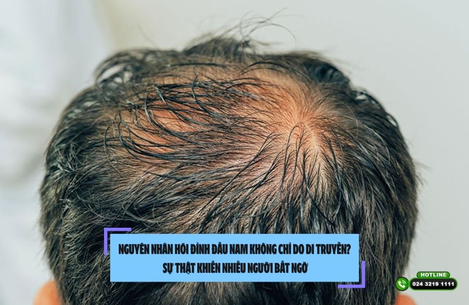 Nguyên nhân hói đỉnh đầu nam không chỉ do di truyền? Sự thật khiến nhiều người bất ngờ