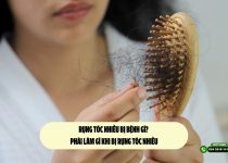 Rụng tóc nhiều bị bệnh gì? Phải làm gì khi bị rụng tóc nhiều