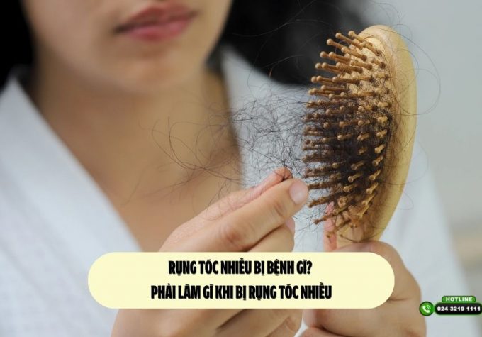 Rụng tóc nhiều bị bệnh gì? Phải làm gì khi bị rụng tóc nhiều