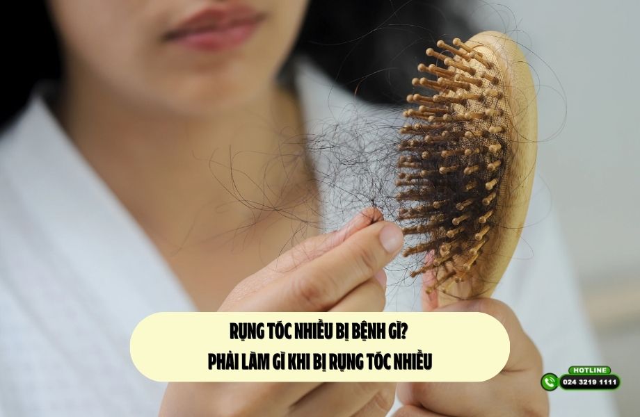 Rụng tóc nhiều bị bệnh gì? Phải làm gì khi bị rụng tóc nhiều