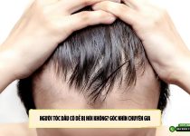 Người tóc dầu có dễ bị hói không? Góc nhìn chuyên gia