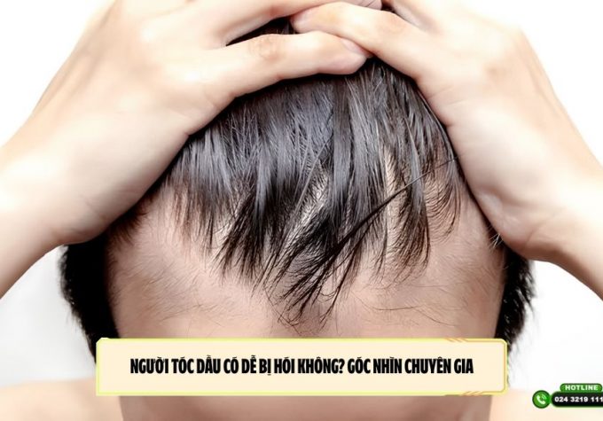 Người tóc dầu có dễ bị hói không? Góc nhìn chuyên gia