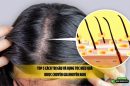 Top 5 cách trị gàu và rụng tóc hiệu quả được chuyên gia khuyến nghị