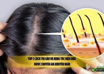 Top 5 cách trị gàu và rụng tóc hiệu quả được chuyên gia khuyến nghị