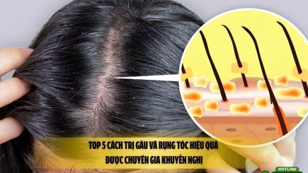 Top 5 cách trị gàu và rụng tóc hiệu quả được chuyên gia khuyến nghị