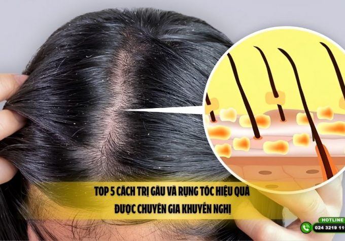 Top 5 cách trị gàu và rụng tóc hiệu quả được chuyên gia khuyến nghị