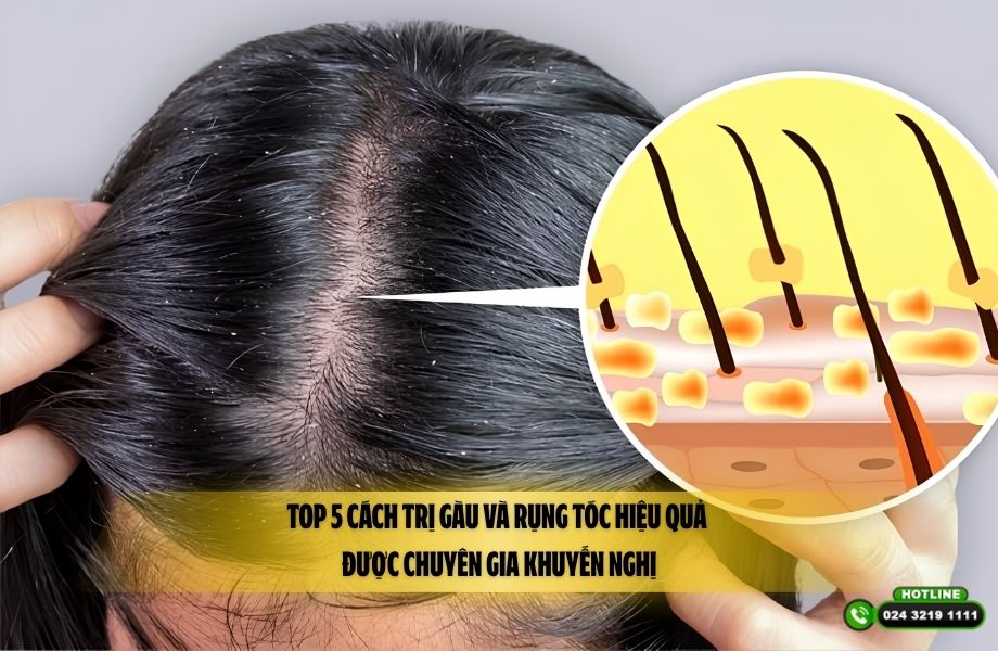 Top 5 cách trị gàu và rụng tóc hiệu quả được chuyên gia khuyến nghị