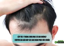 Cấy tóc 1 tháng chưa mọc có sao không? Chuyên gia giải đáp các giai đoạn phục hồi chuẩn