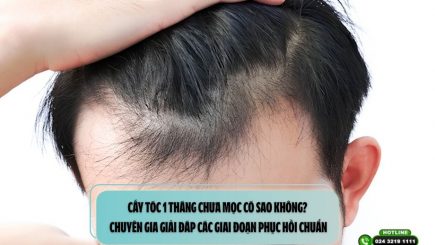 Cấy tóc 1 tháng chưa mọc có sao không? Chuyên gia giải đáp các giai đoạn phục hồi chuẩn