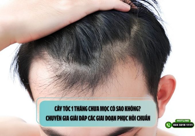 Cấy tóc 1 tháng chưa mọc có sao không? Chuyên gia giải đáp các giai đoạn phục hồi chuẩn