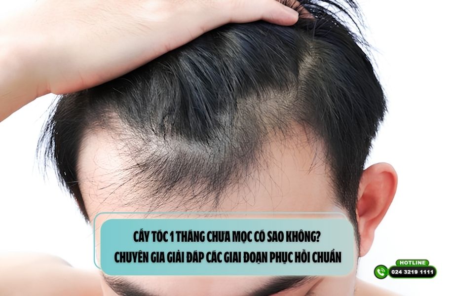 Cấy tóc 1 tháng chưa mọc có sao không? Chuyên gia giải đáp các giai đoạn phục hồi chuẩn