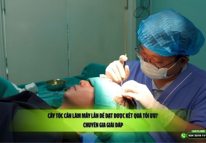 Cấy tóc cần làm mấy lần để đạt được kết quả tối ưu? Chuyên gia giải đáp