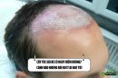 Cấy tóc giá rẻ có nguy hiểm không? Cảnh bảo những rủi ro ít ai ngờ tới