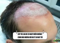 Cấy tóc giá rẻ có nguy hiểm không? Cảnh bảo những rủi ro ít ai ngờ tới