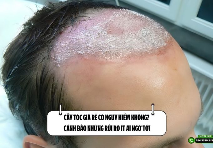 Cấy tóc giá rẻ có nguy hiểm không? Cảnh bảo những rủi ro ít ai ngờ tới