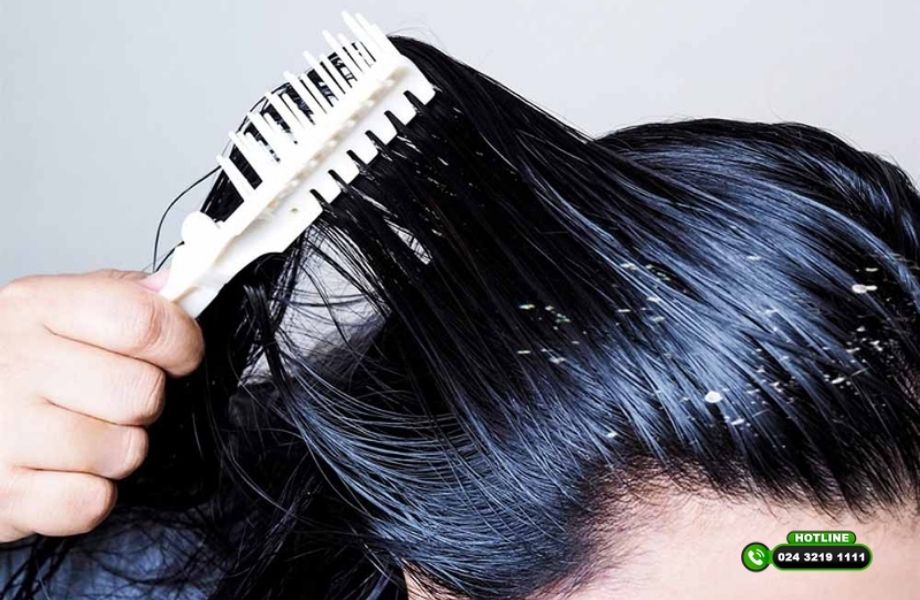 Gàu có làm rụng tóc không? Chuyên gia chỉ ra mối liên hệ ít người để ý