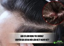 Gàu có làm rụng tóc không? Chuyên gia chỉ ra mối liên hệ ít người để ý