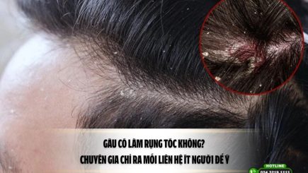 Gàu có làm rụng tóc không? Chuyên gia chỉ ra mối liên hệ ít người để ý