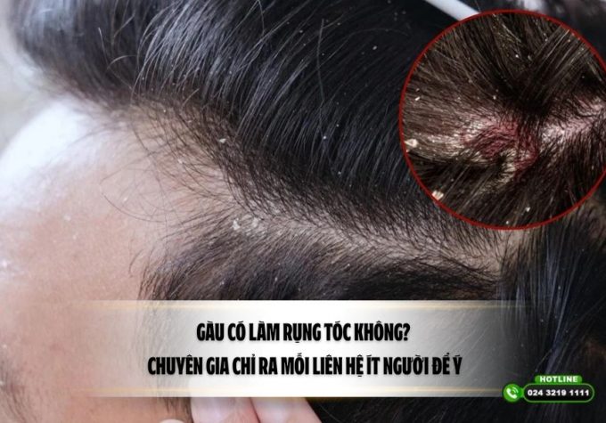 Gàu có làm rụng tóc không? Chuyên gia chỉ ra mối liên hệ ít người để ý