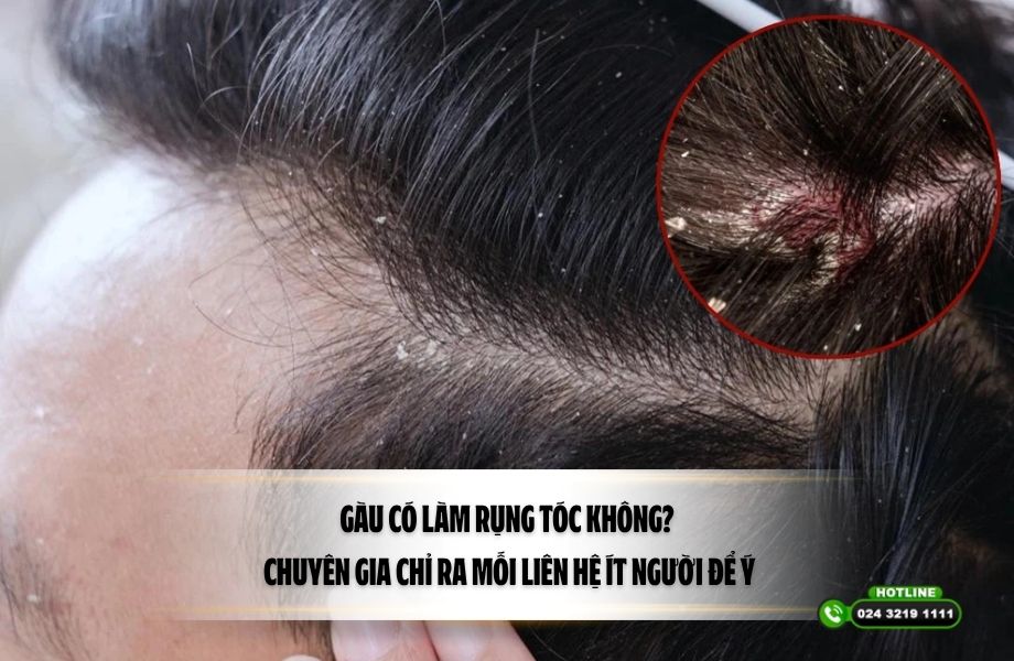 Gàu có làm rụng tóc không? Chuyên gia chỉ ra mối liên hệ ít người để ý