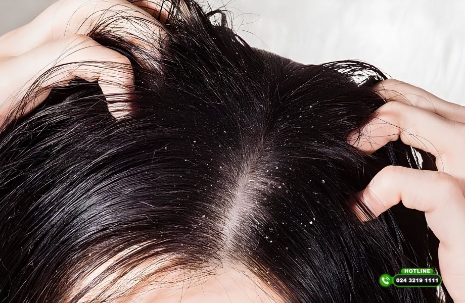 Nguyên nhân bị gàu và rụng tóc: Không chỉ do vệ sinh kém như nhiều người vẫn nghĩ
