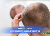 Hói xoáy tóc ở đỉnh đầu: Nguyên nhân, dấu hiệu và hướng cải thiện hiệu quả