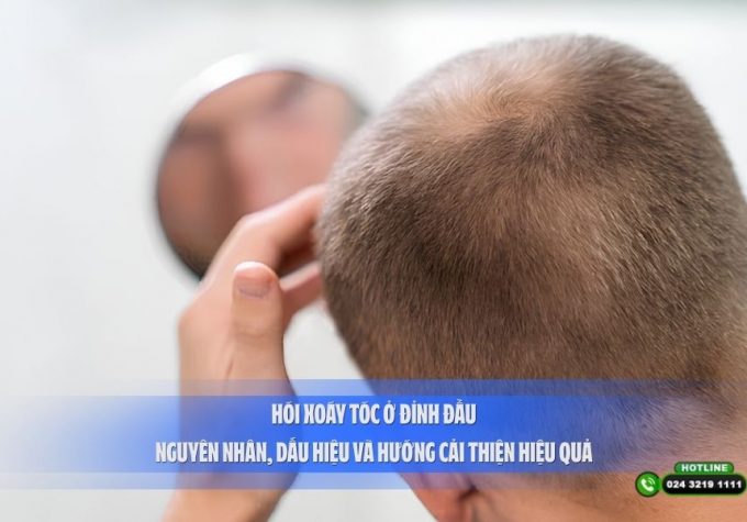 Hói xoáy tóc ở đỉnh đầu: Nguyên nhân, dấu hiệu và hướng cải thiện hiệu quả