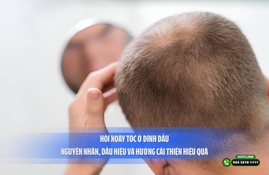 Hói xoáy tóc ở đỉnh đầu: Nguyên nhân, dấu hiệu và hướng cải thiện hiệu quả