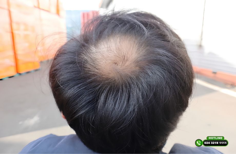 Hói xoáy tóc ở đỉnh đầu: Nguyên nhân, dấu hiệu và hướng cải thiện hiệu quả