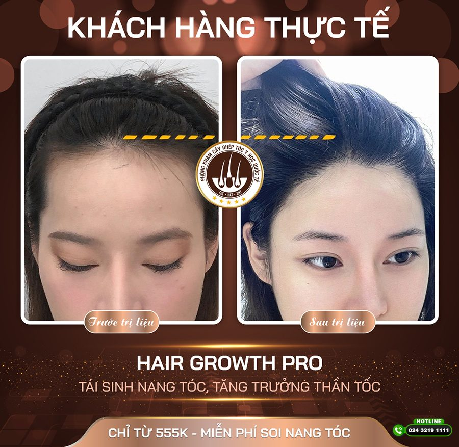 Rụng tóc sau giảm cân có mọc lại không? Phân tích khả năng phục hồi theo từng trường hợp