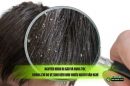 Nguyên nhân bị gàu và rụng tóc: Không chỉ do vệ sinh kém như nhiều người vẫn nghĩ