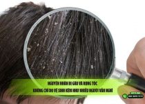 Nguyên nhân bị gàu và rụng tóc: Không chỉ do vệ sinh kém như nhiều người vẫn nghĩ