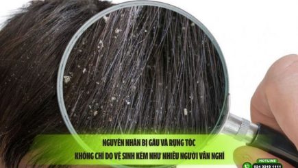 Nguyên nhân bị gàu và rụng tóc: Không chỉ do vệ sinh kém như nhiều người vẫn nghĩ