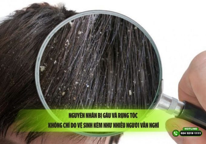 Nguyên nhân bị gàu và rụng tóc: Không chỉ do vệ sinh kém như nhiều người vẫn nghĩ