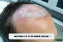 Như thế nào là cấy tóc thất bại và cách khắc phục