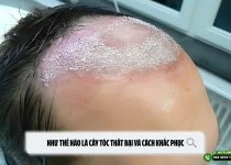 Như thế nào là cấy tóc thất bại và cách khắc phục