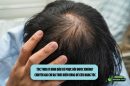 Tóc thưa ở đỉnh đầu có phục hồi được không? Chuyên gia chỉ ra thời điểm vàng để cứu nang tóc