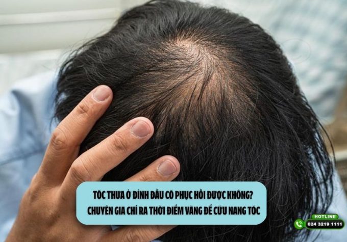Tóc thưa ở đỉnh đầu có phục hồi được không? Chuyên gia chỉ ra thời điểm vàng để cứu nang tóc