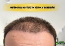 Chuyên gia giải đáp: Vì sao tóc mới mọc bị xoăn sau cấy?