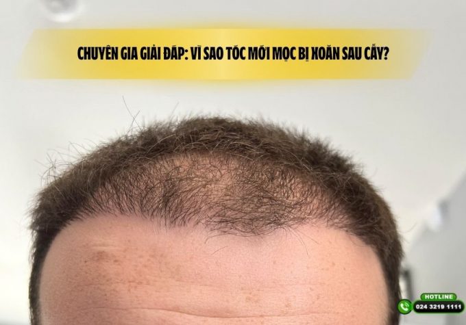 Chuyên gia giải đáp: Vì sao tóc mới mọc bị xoăn sau cấy?