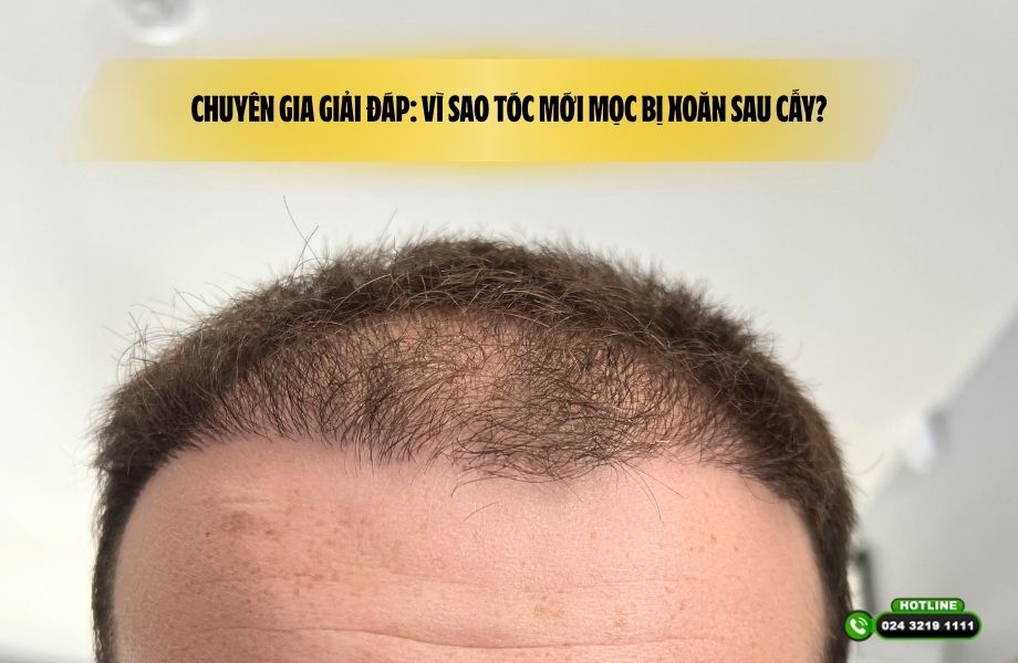 Chuyên gia giải đáp: Vì sao tóc mới mọc bị xoăn sau cấy?