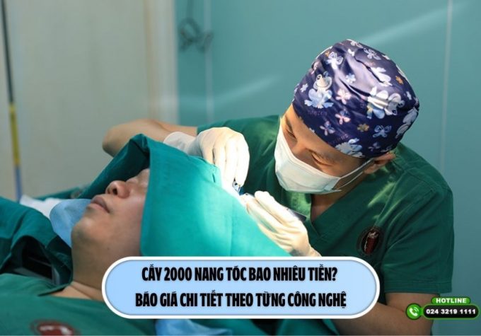 Cấy 2000 nang tóc bao nhiêu tiền? Báo giá chi tiết theo từng công nghệ