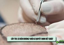 Cấy tóc có bền không? Điều gì quyết định kết quả?